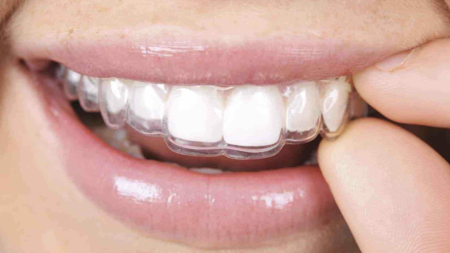 Invisalign vs Braces: Which is Better?